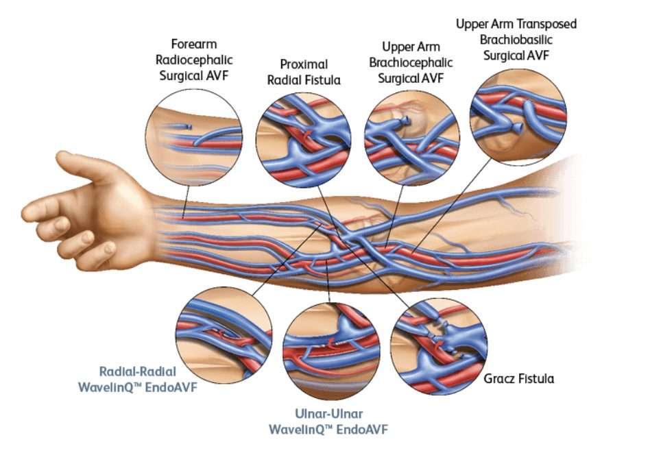 Dialysis Access & Percutaneous AV Fistula Creation Pittsburgh